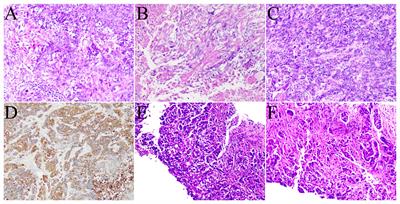 Primary thyroid squamous cell carcinoma diagnosed with 18F-FDG PET/CT: a case report